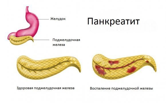 Панкреатит в домашних условиях Панкреатит в домашних условиях