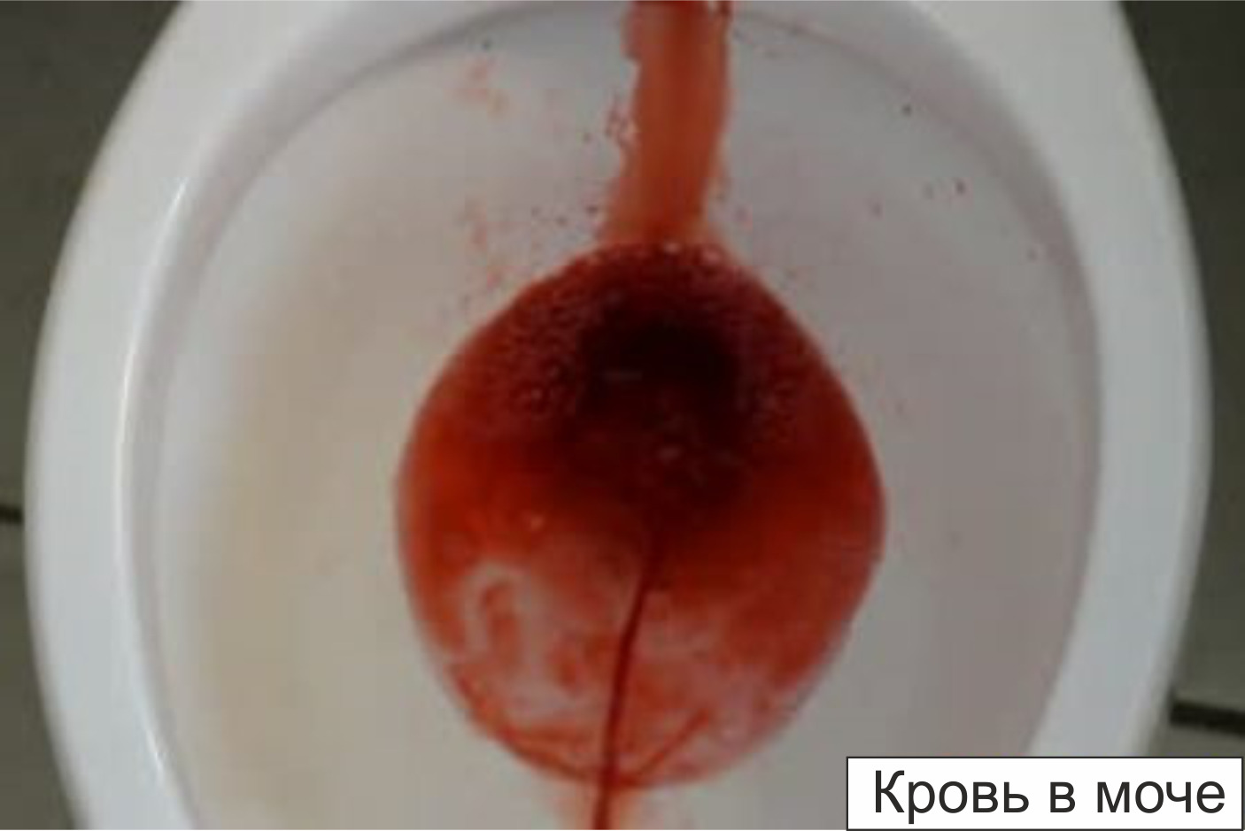кровь в моче в сперме у мужчин причины фото 5