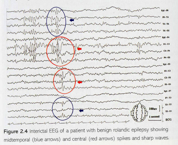 Ээг показывает эпилепсию. Эпилепсия на снимках ЭЭГ. ЭЭГ при эпилепсии расшифровка. Затылочная эпилепсия ЭЭГ. Пики при ЭЭГ при эпилепсии.
