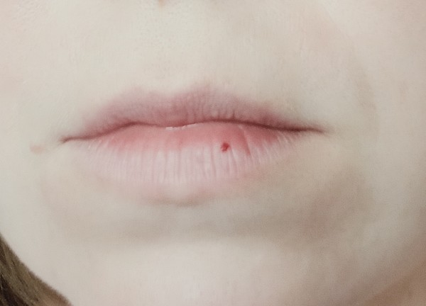 🚼пациент: 10 лет 💉диагноз: гемангиома губы ✔️ На последнем фото пациент п | Instagram